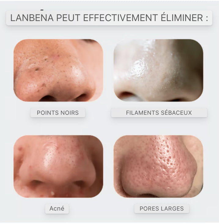 LANBENA™ Crème Anti-Points Noirs et Impuretés - Votre secret pour une peau éclatante